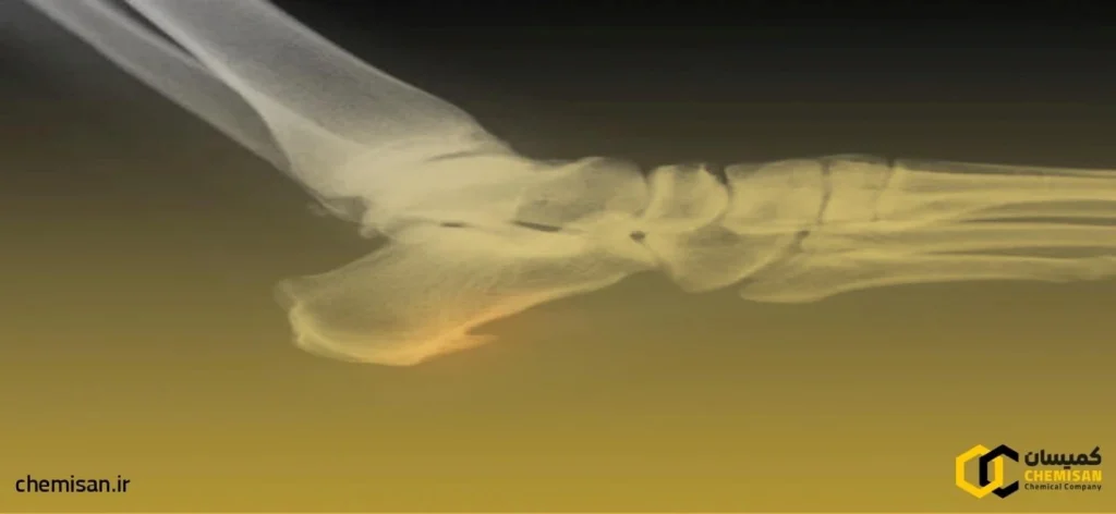 آشنایی با خار پاشنه و علائم آن